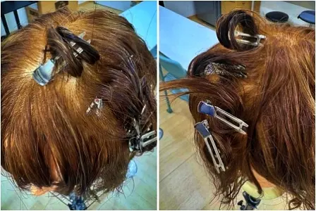 ピンで止めていくと施術が行いやすい